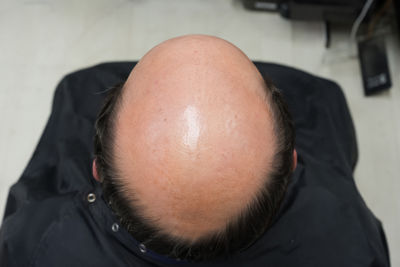 Antes de micropigmentación capilar efecto rapado en Córdoba - alopecia avanzada